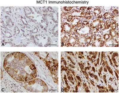 MCT1 in Invasive Ductal Carcinoma: Monocarboxylate Metabolism and Aggressive Breast Cancer